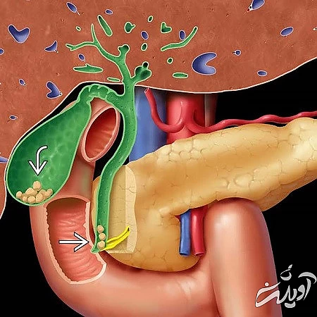 روش پیشگیری از ابتلا به لجن صفراوی پیروی  سنگ های صفراوی, لجن صفرا, پاکسازی لجن صفرا